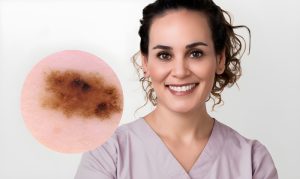 Especialista en cáncer de la piel melanoma