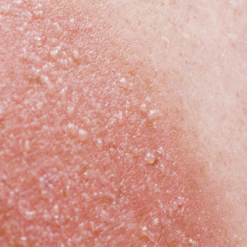 7-dermatologist-approved-tips-to-relief-sunburn-bellphoria