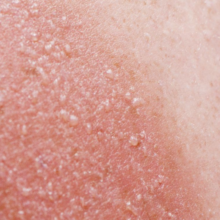 Dermatologist Approved Tips To Relief Sunburn Bellphoria