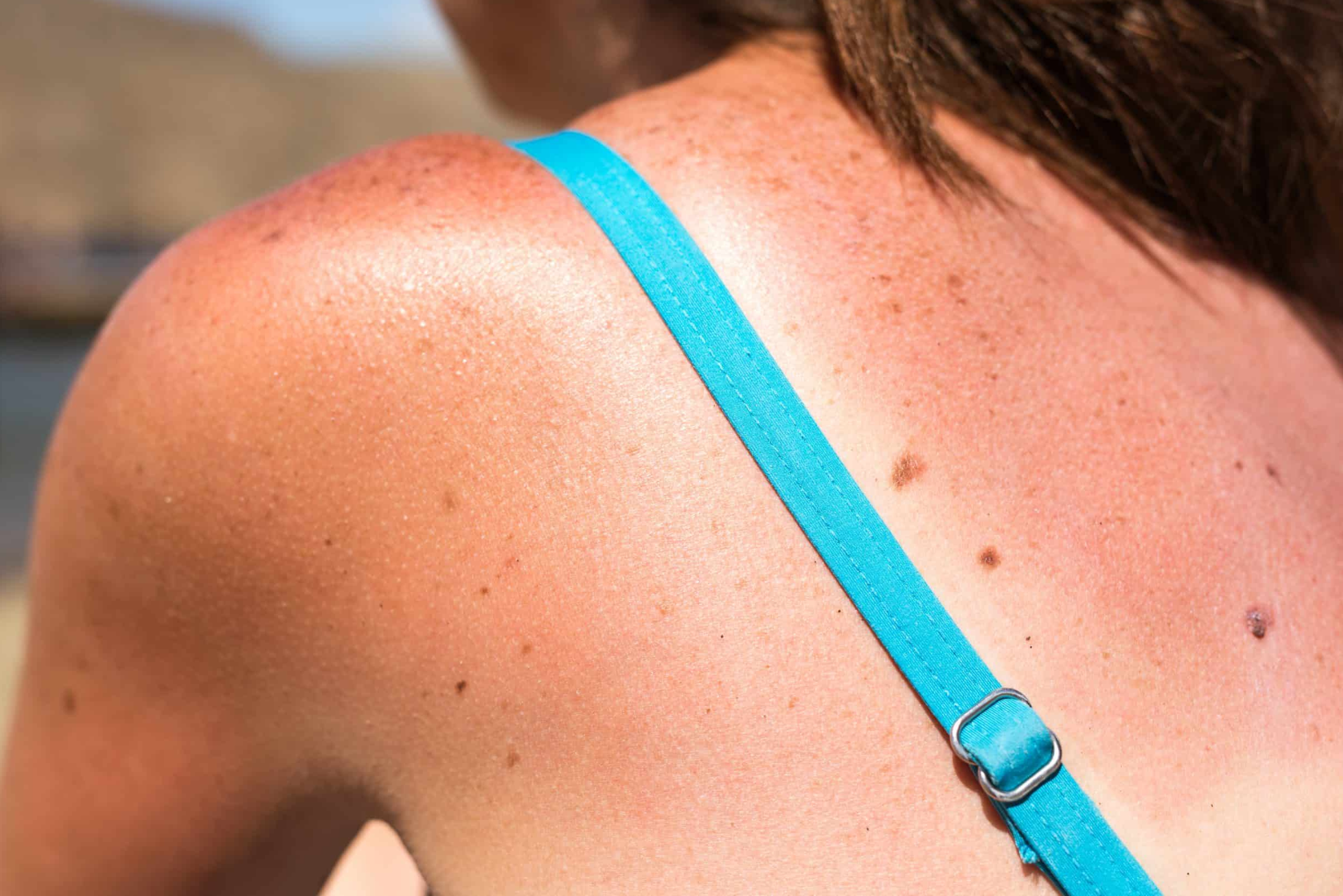 7 Natural Home Remedies for Sunburn Relief