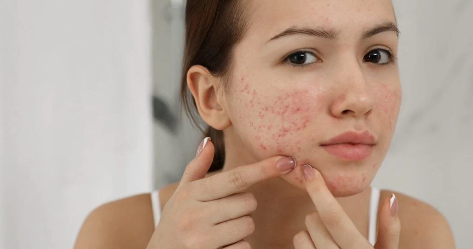 How To Get Rid Of Acne Scars Bellphoria