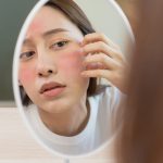 Eczem facial y el maquillaje