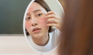 Eczem facial y el maquillaje