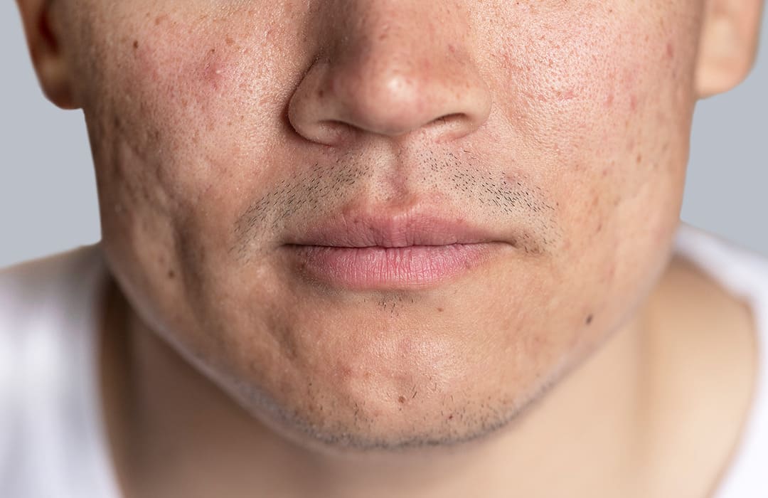 tratamiento de marcas de acne en tijuana, san diego